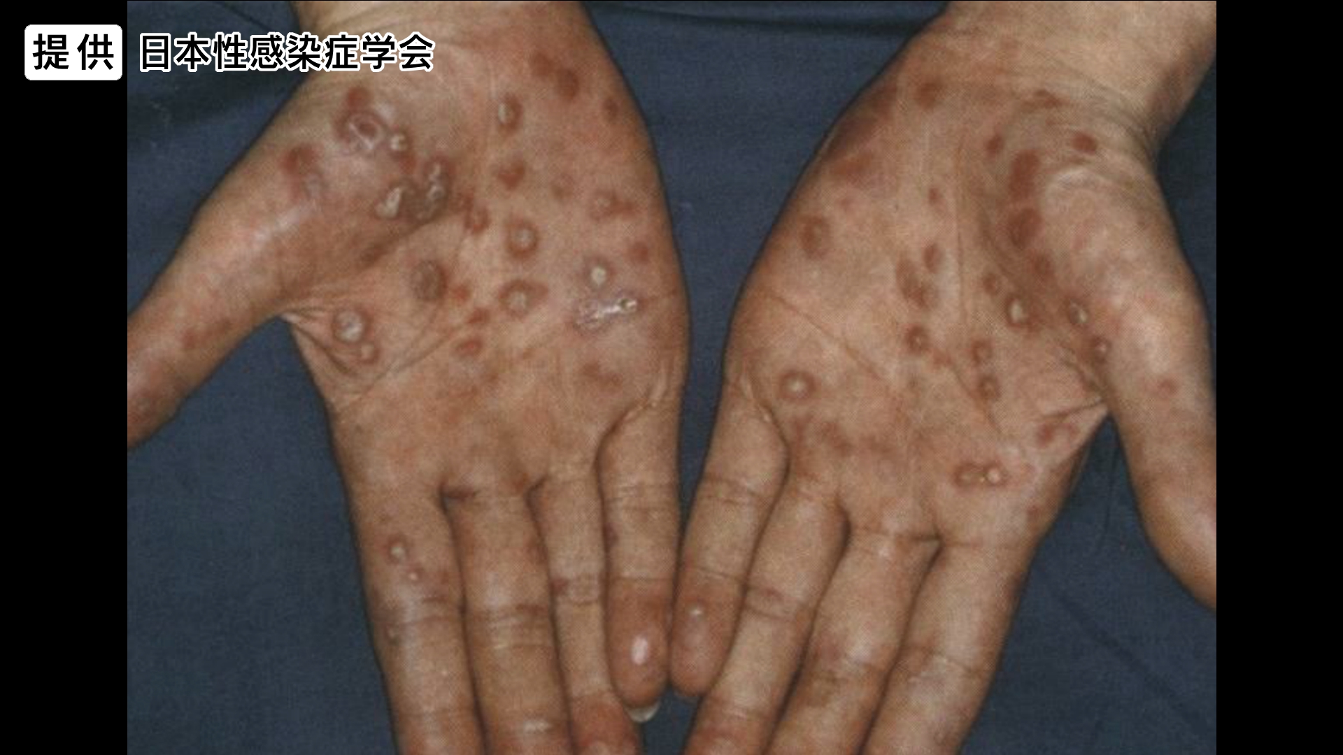 10代10代女子 性器画像 性感染症「梅毒」が全国で拡大 SNS、マッチングアプリでの出会い背景か 若者からシニア世代まで…男性20~60代、女性10~40代 地方でも急増 長野県で“過去最多” 保健所では匿名・無料で検査 | 長野県内のニュース | NBS 長野放送