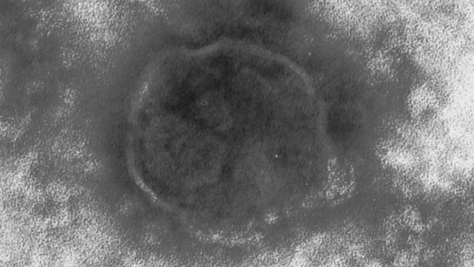 はしかに感染の40代女性が「特急しなの」塩尻駅ー名古屋駅を利用　前日にせきや鼻水の症状、その後、熱や発疹　鹿児島県で陽性確認　長野県が注意呼びかけ